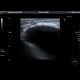 Breast implant: US - Ultrasound